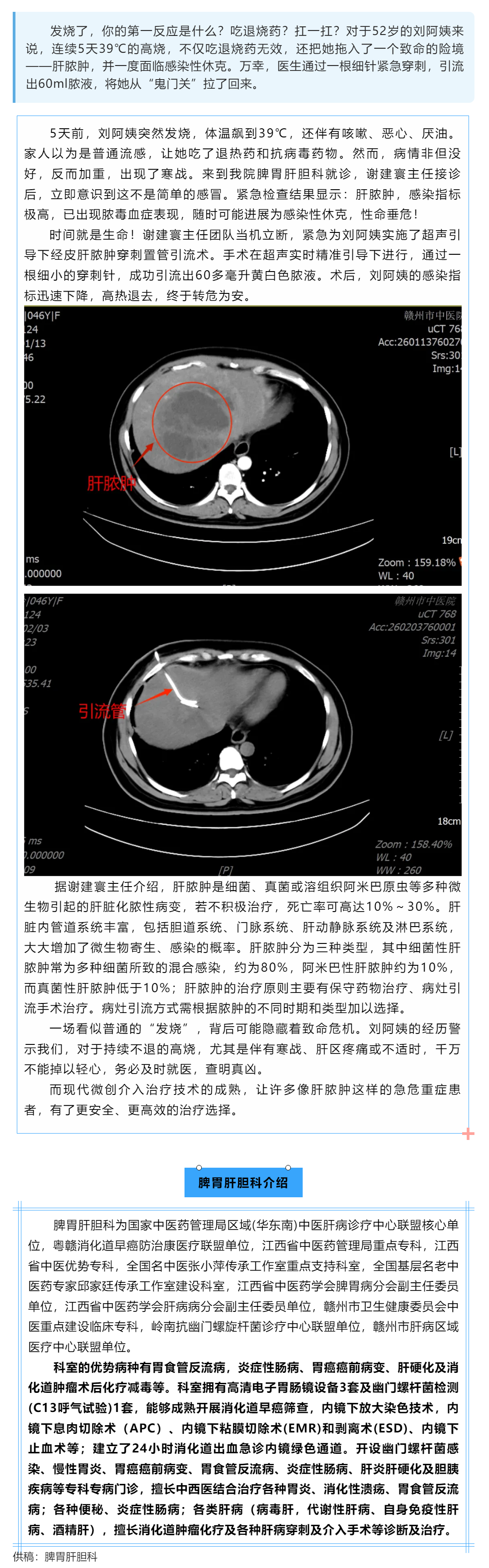 高烧39℃不退，元凶竟是肝脓肿！微创穿刺&ldquo;引流&rdquo;，一根细针化解致命危机.png
